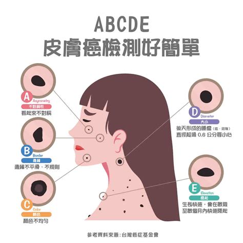 皮膚癌|皮膚長痣、長斑是皮膚癌前兆？皮膚癌初期4大症狀快。